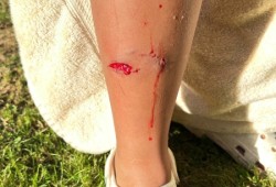 Taiaha Watts, 10, shows his river otter bite that required six to eight stitches. (Len Watts photo)